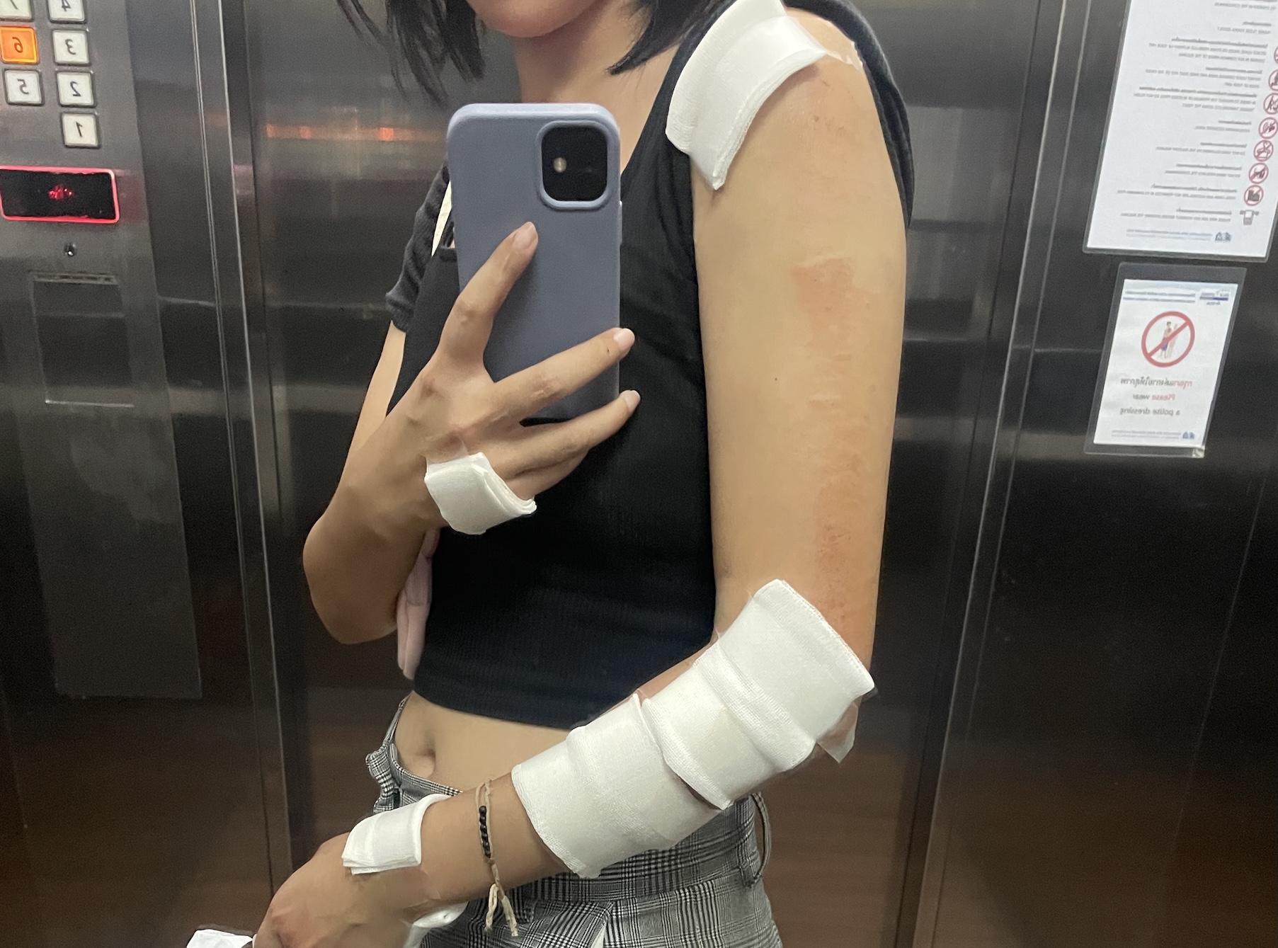 Scooter and motorcycle accident road rash injuries